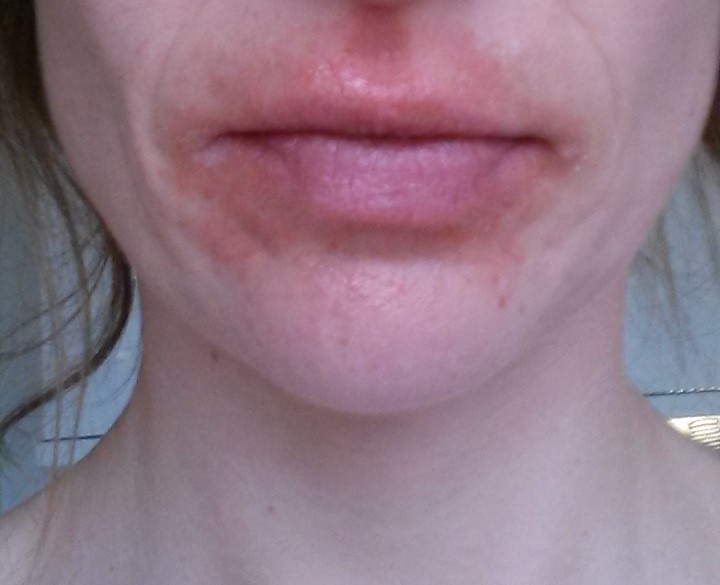 Eczema Eczema Mouth Corners
